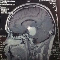脑胶质瘤晚期症状